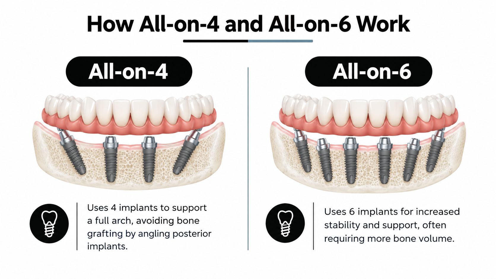 A dental comparison infographic showing the structural differences between All-on-4 and All-on-6 implant-supported bridge procedures.