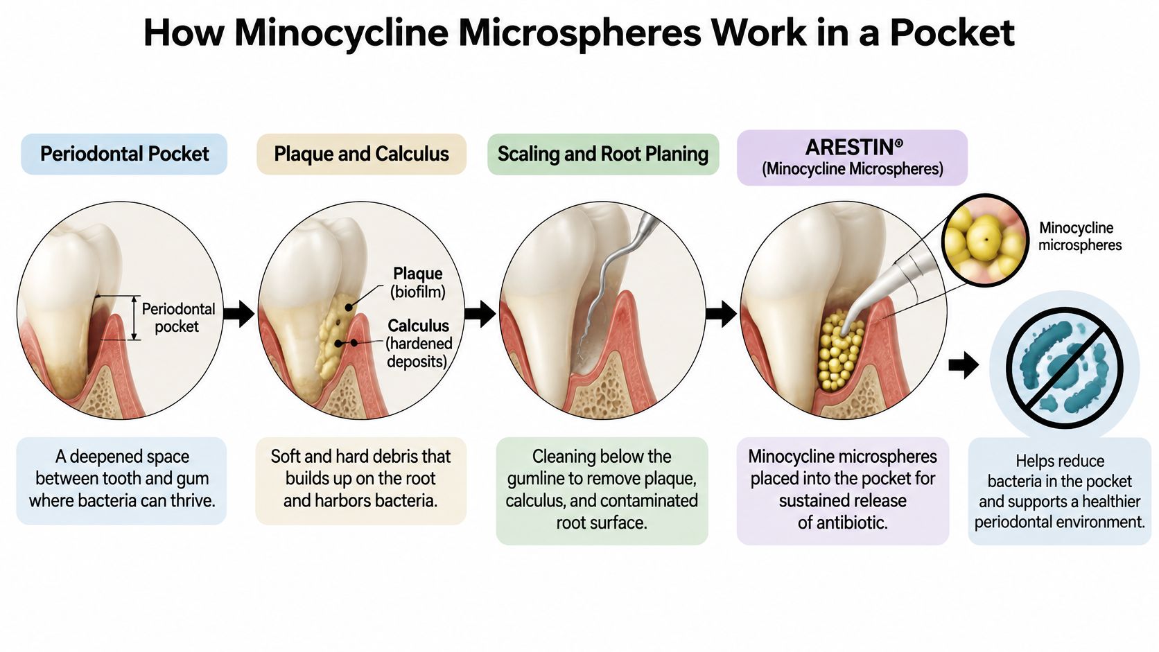 A diagram illustrating how Arestin minocycline microspheres treat periodontal pockets by reducing bacteria after dental scaling procedures.