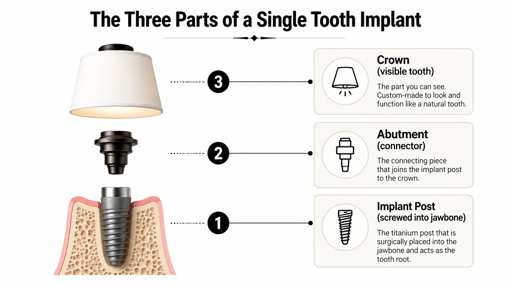 An infographic detailing the three essential components of a dental implant: the crown, abutment, and post.