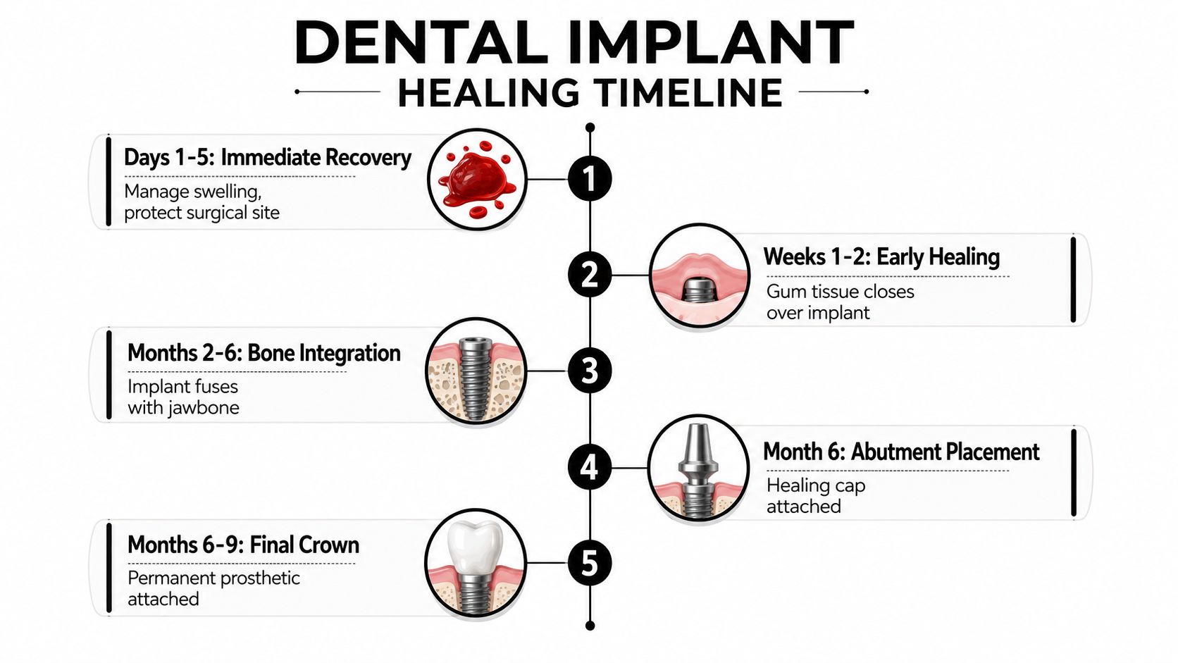 A dental implant healing timeline infographic illustrating five stages from initial surgery to final crown placement.