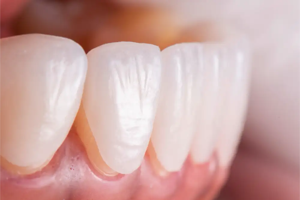 Veneers Treatment in Manhattan, NY