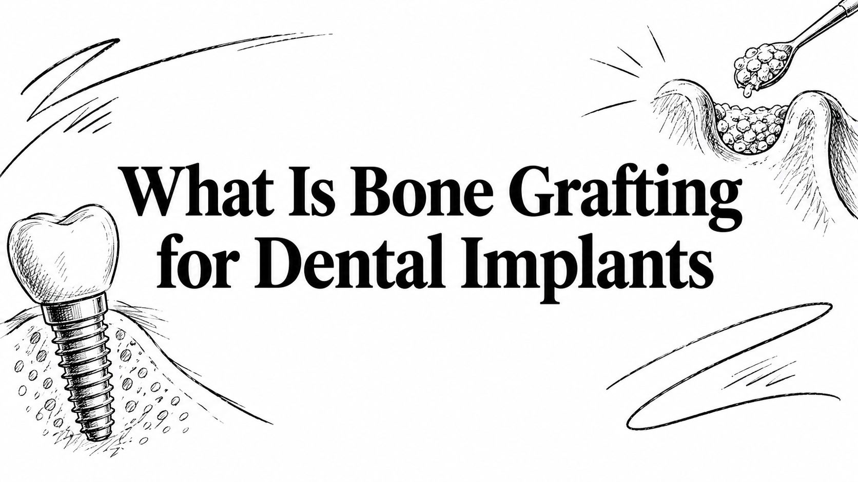 What Is Bone Grafting For Dental Implants Bone Graft