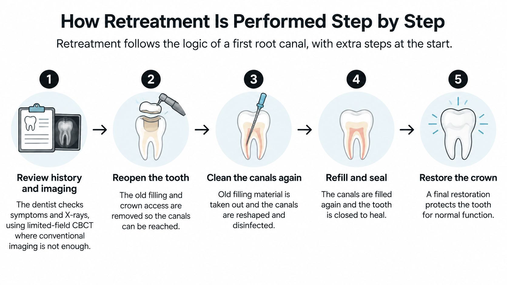 A five-step infographic showing the step-by-step process of performing a dental root canal retreatment procedure.