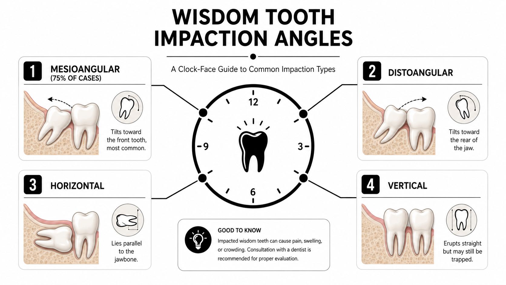 An educational infographic showing four different angles of wisdom tooth impaction with brief descriptions for each.